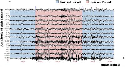 Efficient and generalizable cross-patient epileptic seizure detection through a spiking neural network